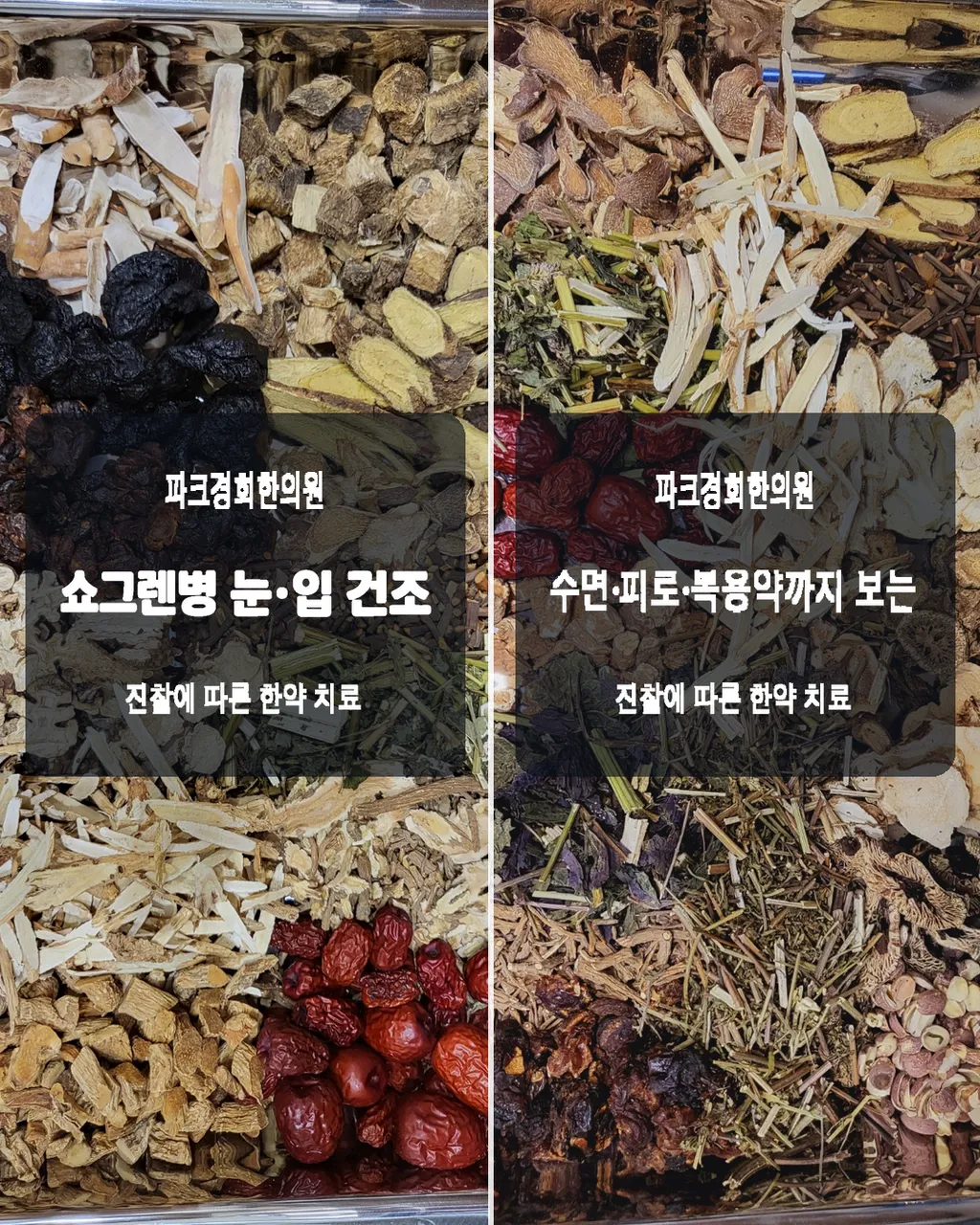 춘천 쇼그렌 증후군으로 눈·입 건조 파크경희한의원, 침·약침·한약 치료가 쇼그렌병을 어떻게 도울까요 6.png