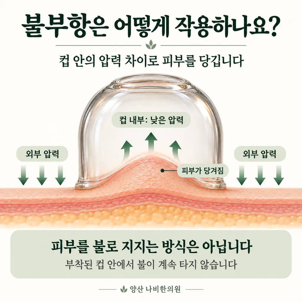 fire-cupping-negative-pressure.png