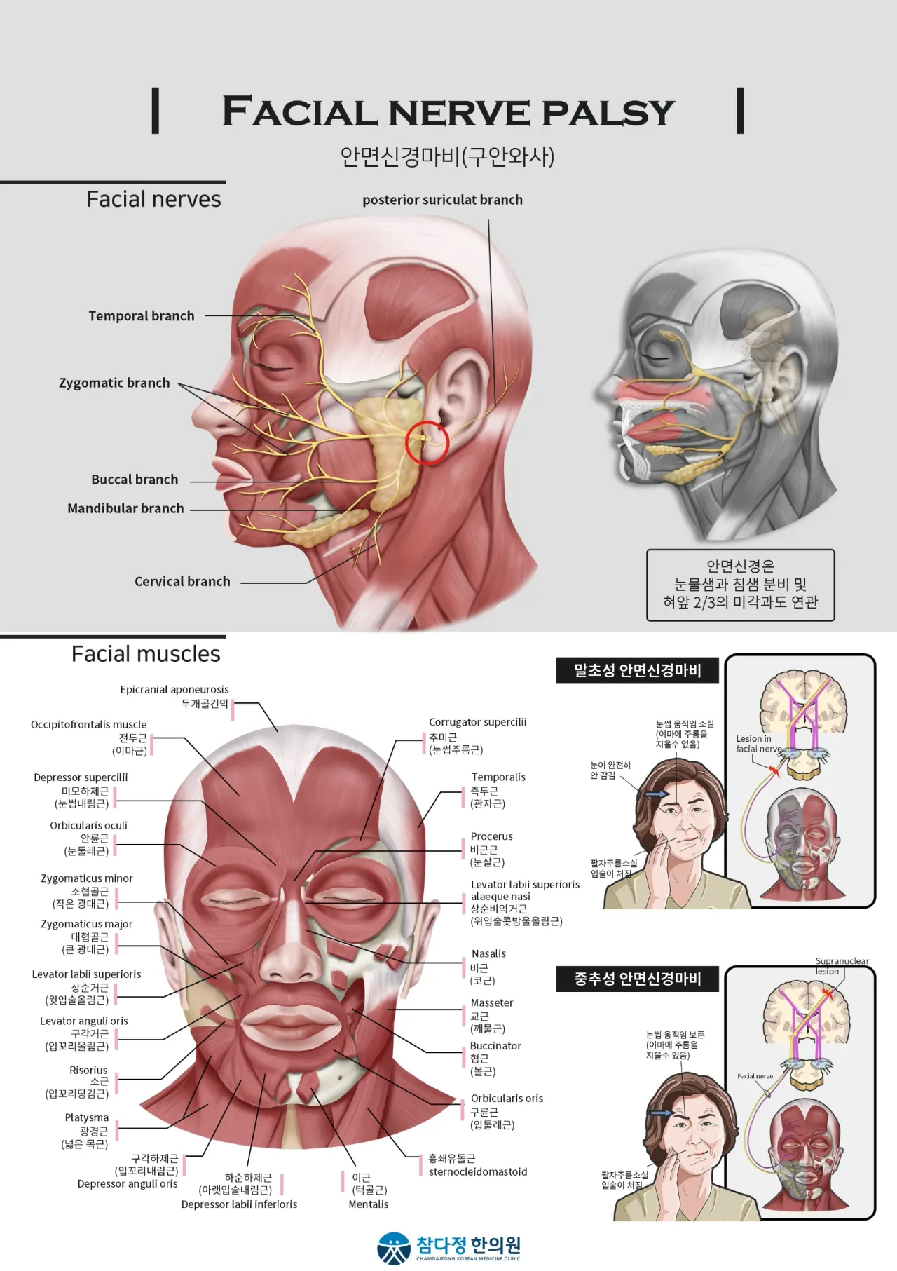________39 안면신경마비.webp