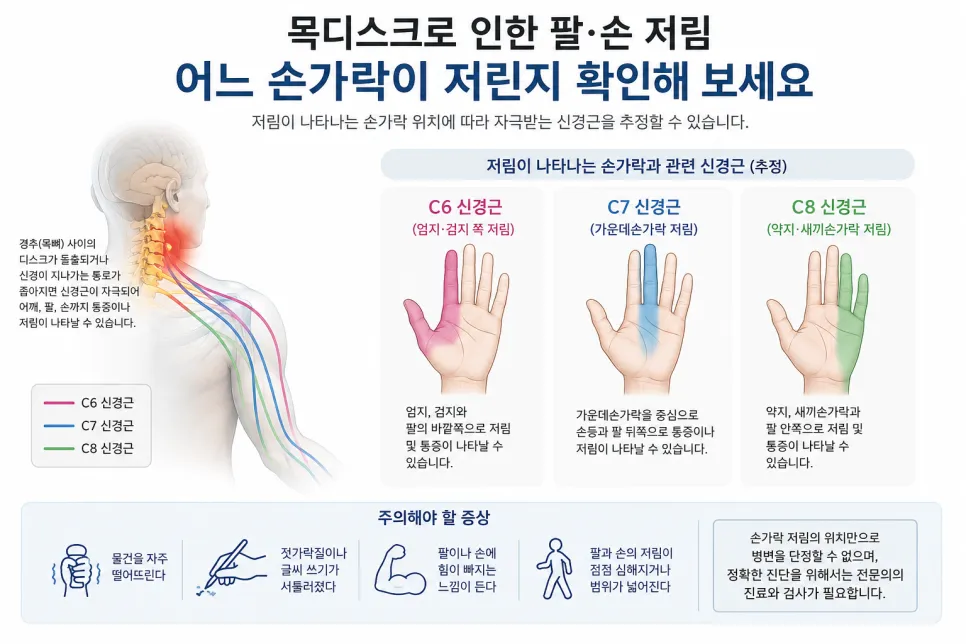 목디스크 팔 저림, 어느 손가락이 저린지 확인해 보세요