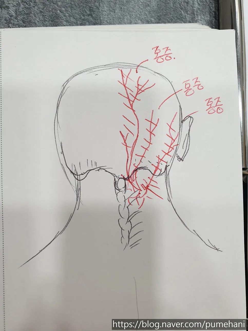 두통의 종류. 뒷목, 뒷골통증, 후두통, 긴장두통 (전주늘품애한의원 건강정보)