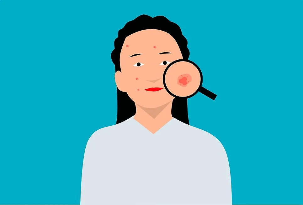 여드름, 피부 문제가 아니다? 아현역 한의원에서 보는 5가지 체질 유형과 원인