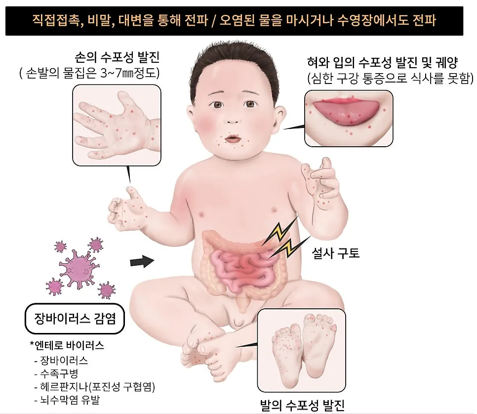 피부에 나타나는성홍열, 풍진, 홍역, 수족구병의 감염양상 및 발진증상