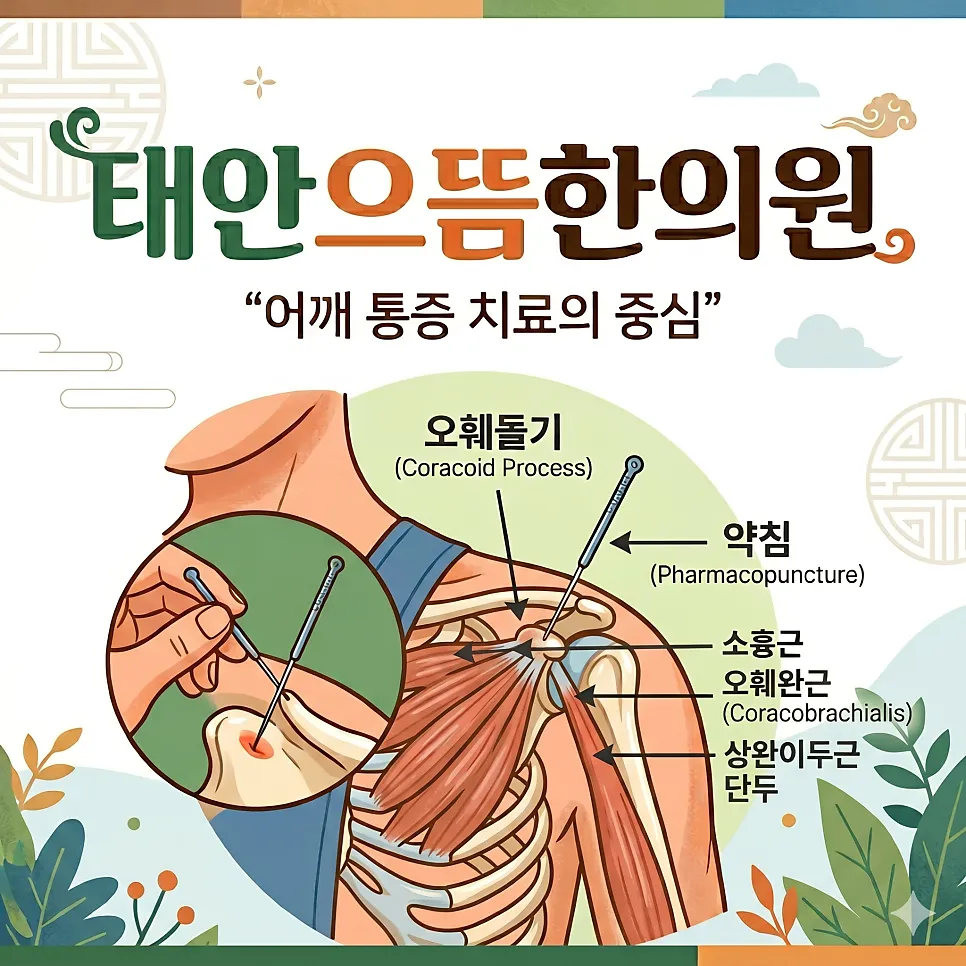 어깨 앞이 아파요? - 태안 한의원-
