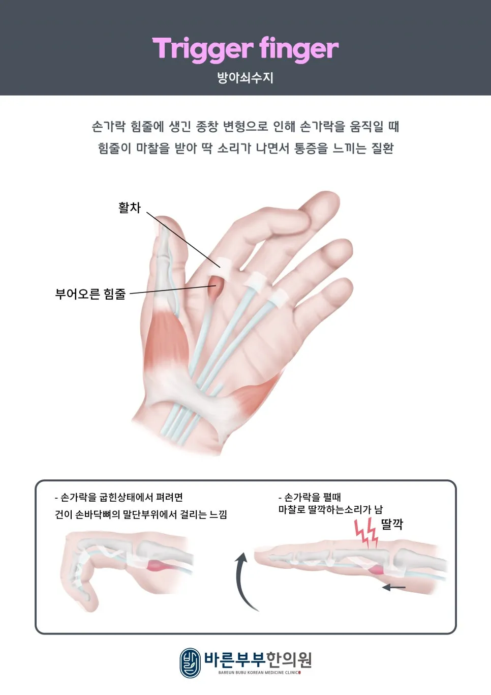 [나주 빛가람동 한의원/초음파 약침] 방아쇠 손가락, 한의원에선 어떻게 치료할까요?