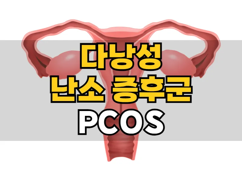 불규칙한 월경주기, 방치하면 불임까지? 다낭성 난소 증후군 (PCOS)