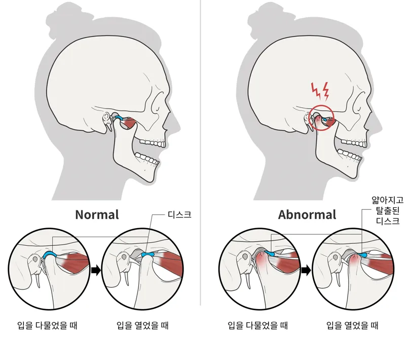 예반 턱관절 치료가 특별한 점