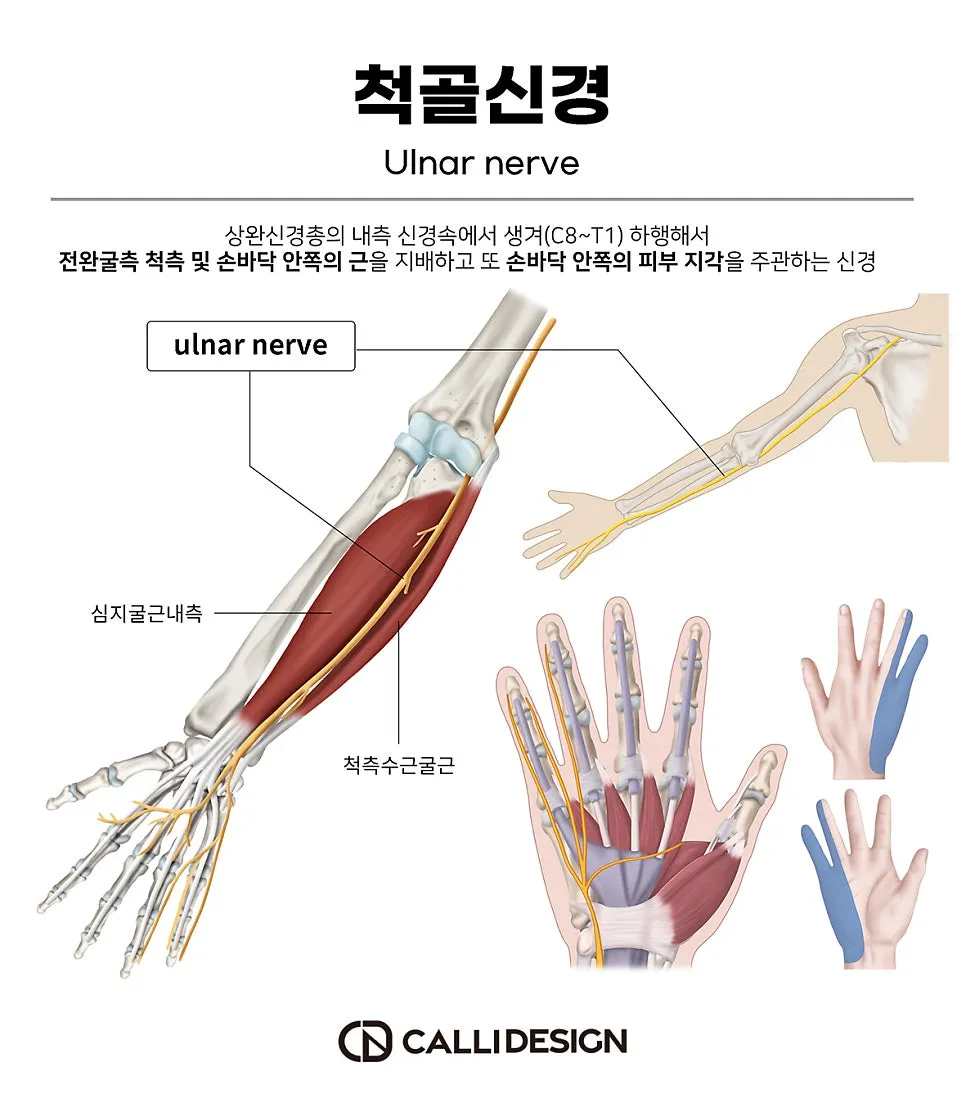 팔꿈치 내측의 통증과 함께 새끼 손가락이 저리다면? 척골신경증후군을 의심해볼 수 있습니다. (군산 명작한의원)