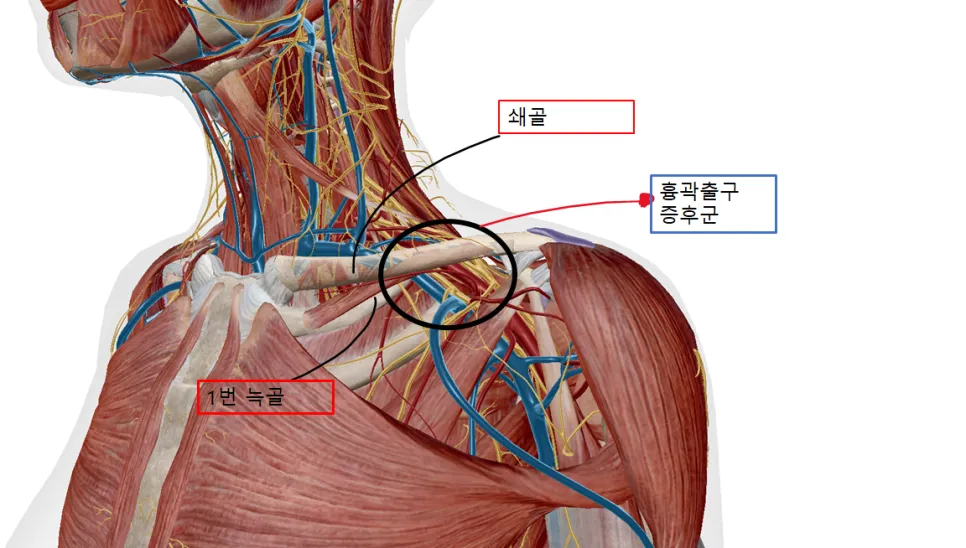 목 디스크가 아닌 손저림 - 흉곽출구 증후군