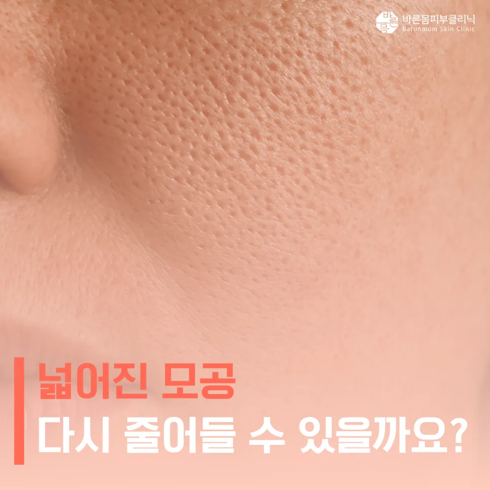 넓어진 모공 다시 줄어들 수 있을까요? 모공이 커 보이는 이유