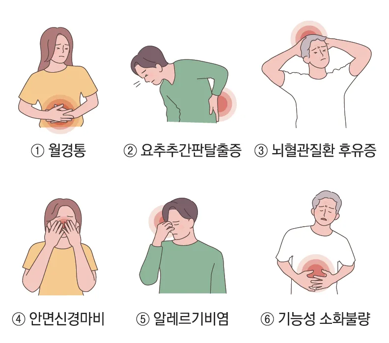 알레르기 비염 - 한약(첩약) 건강보험 시작~