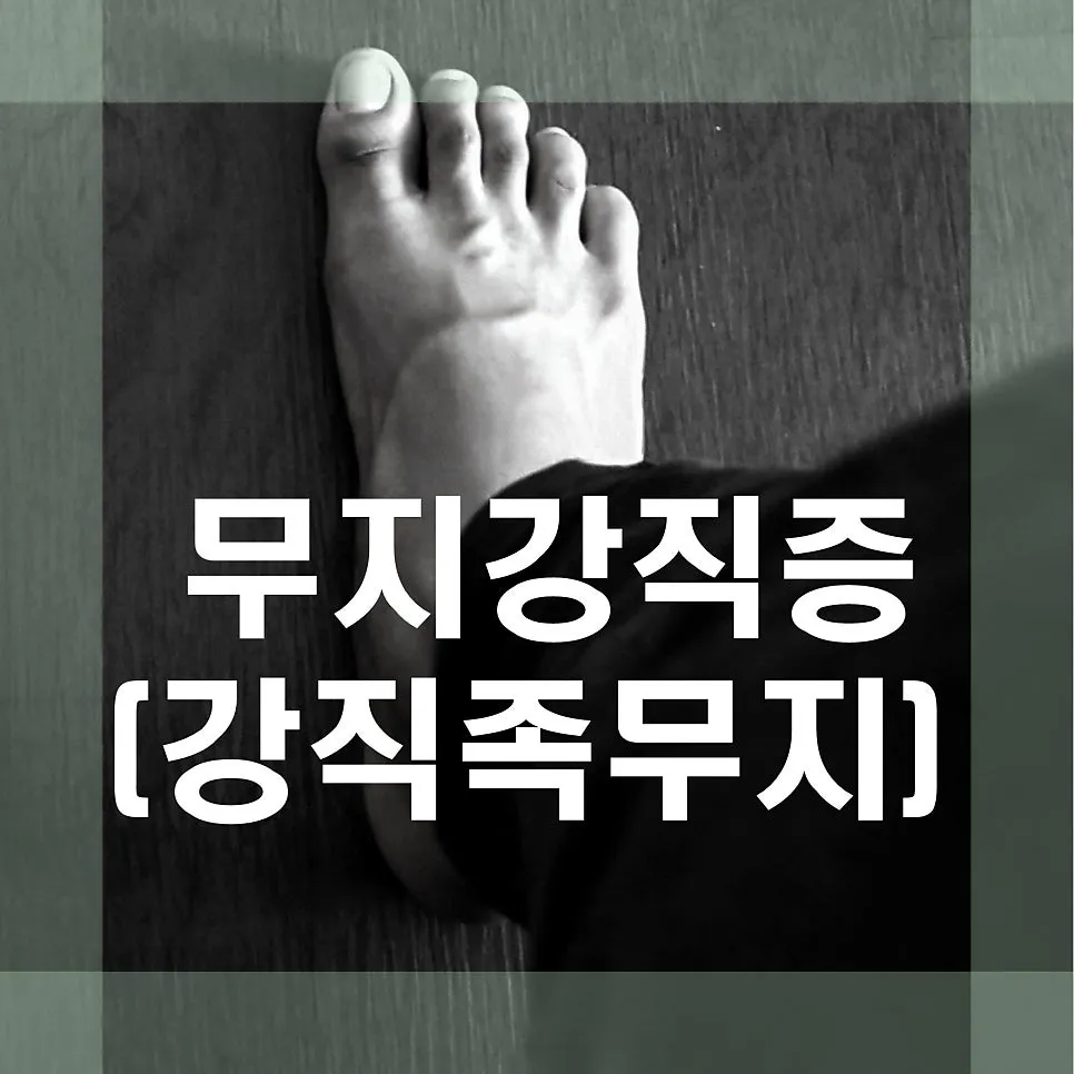 발가락 들때 아픈 무지강직증 증상 및 치료