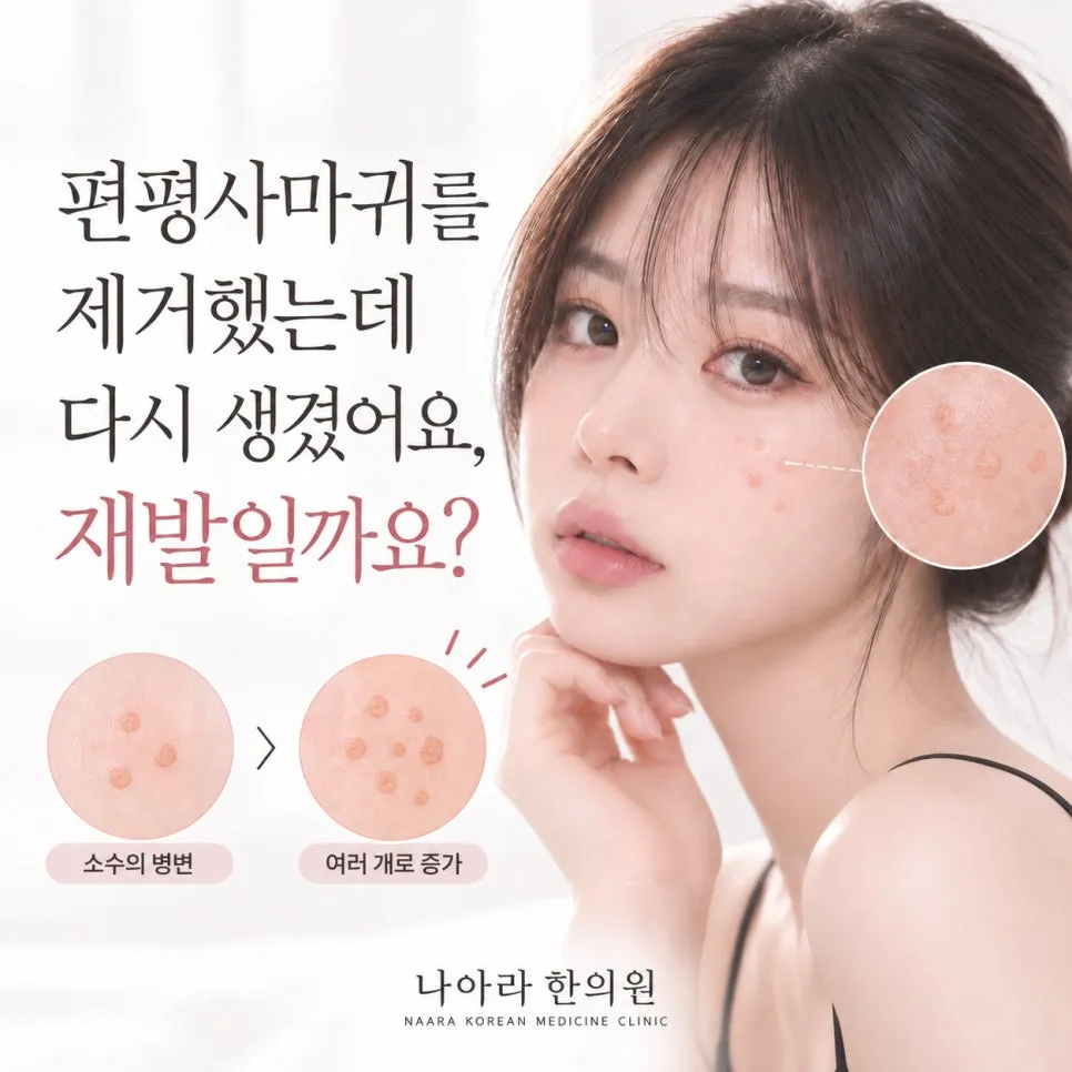 편평사마귀를 제거했는데 다시 생겼어요, 재발일까요?