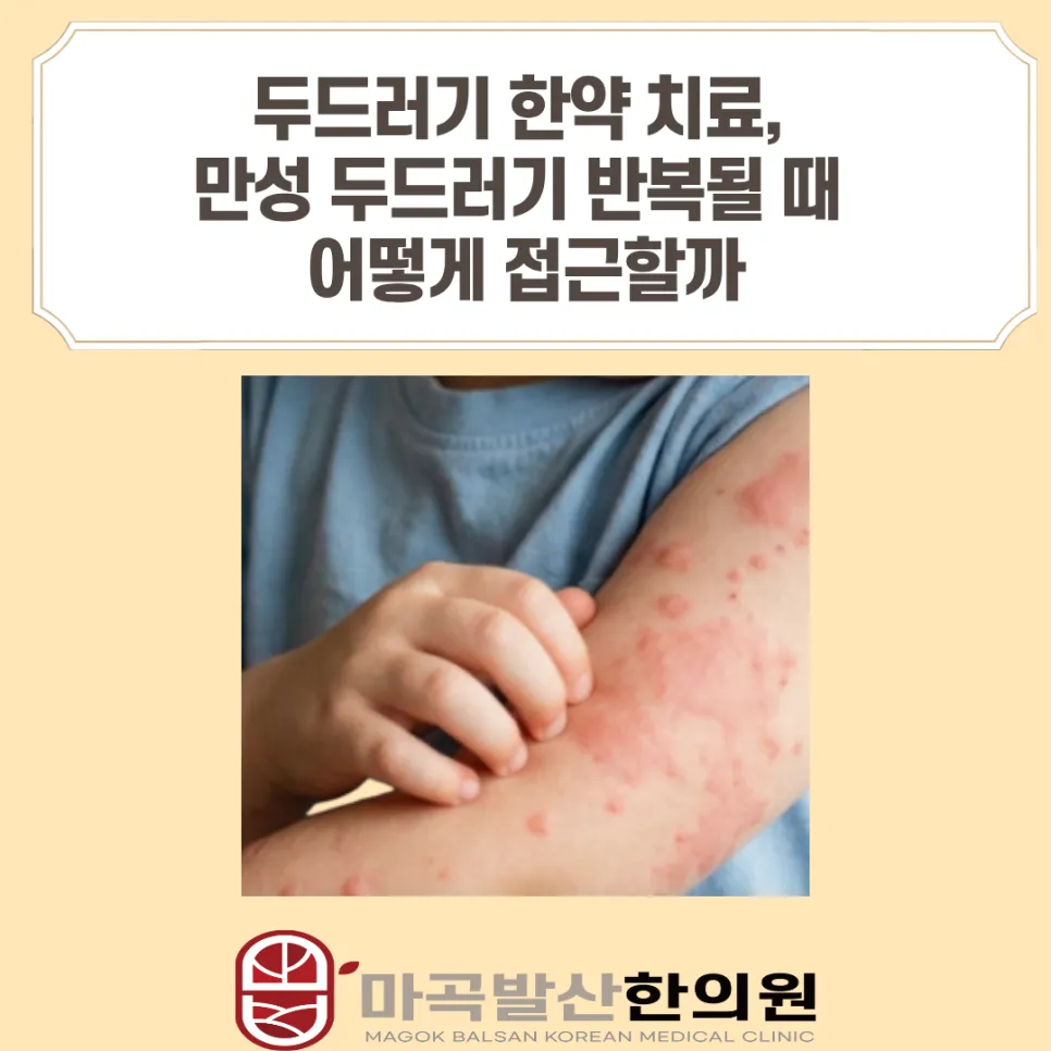 두드러기 한약 치료, 만성 두드러기 반복될 때 어떻게 접근할까 - 강서구 마곡발산한의원