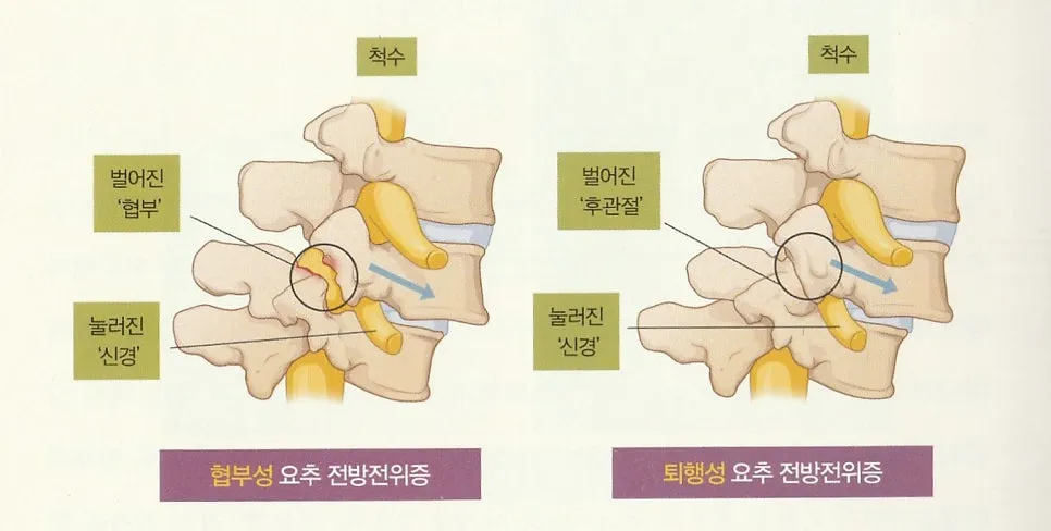 마곡 추나 한의원 척추전방전위증 원인과 치료