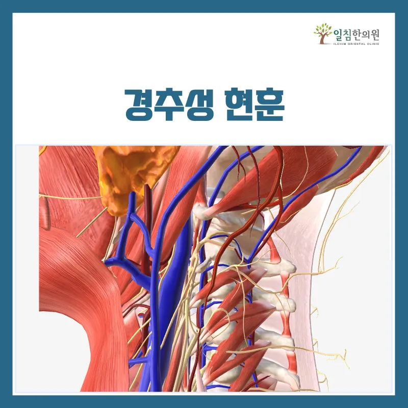 경추성 현훈(어지러움) : 상부경추디스크에서 흔한 증상