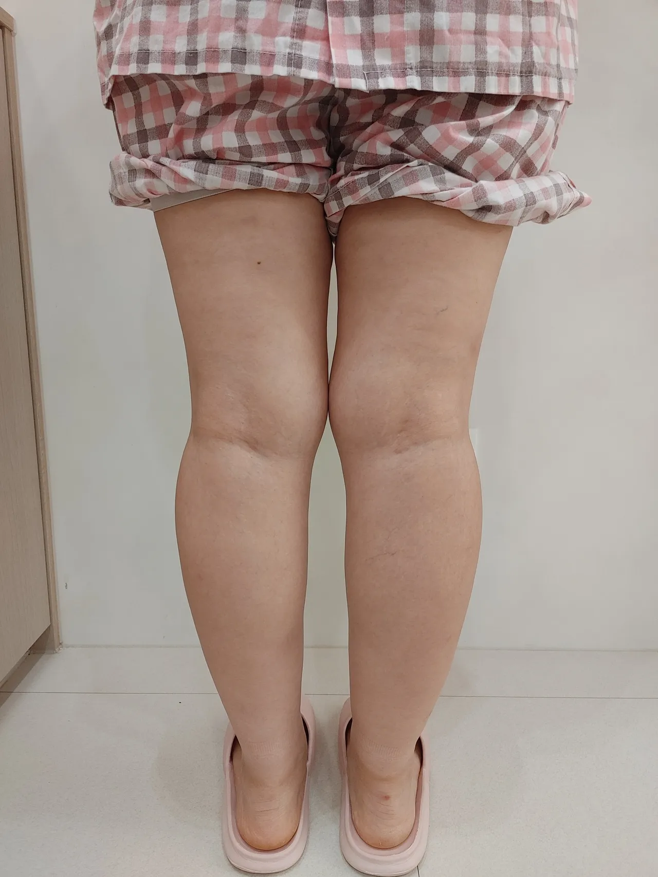 태음 체질 하지부종 개선 - 라인약침 + 림프추나 5회차 전후 - Before