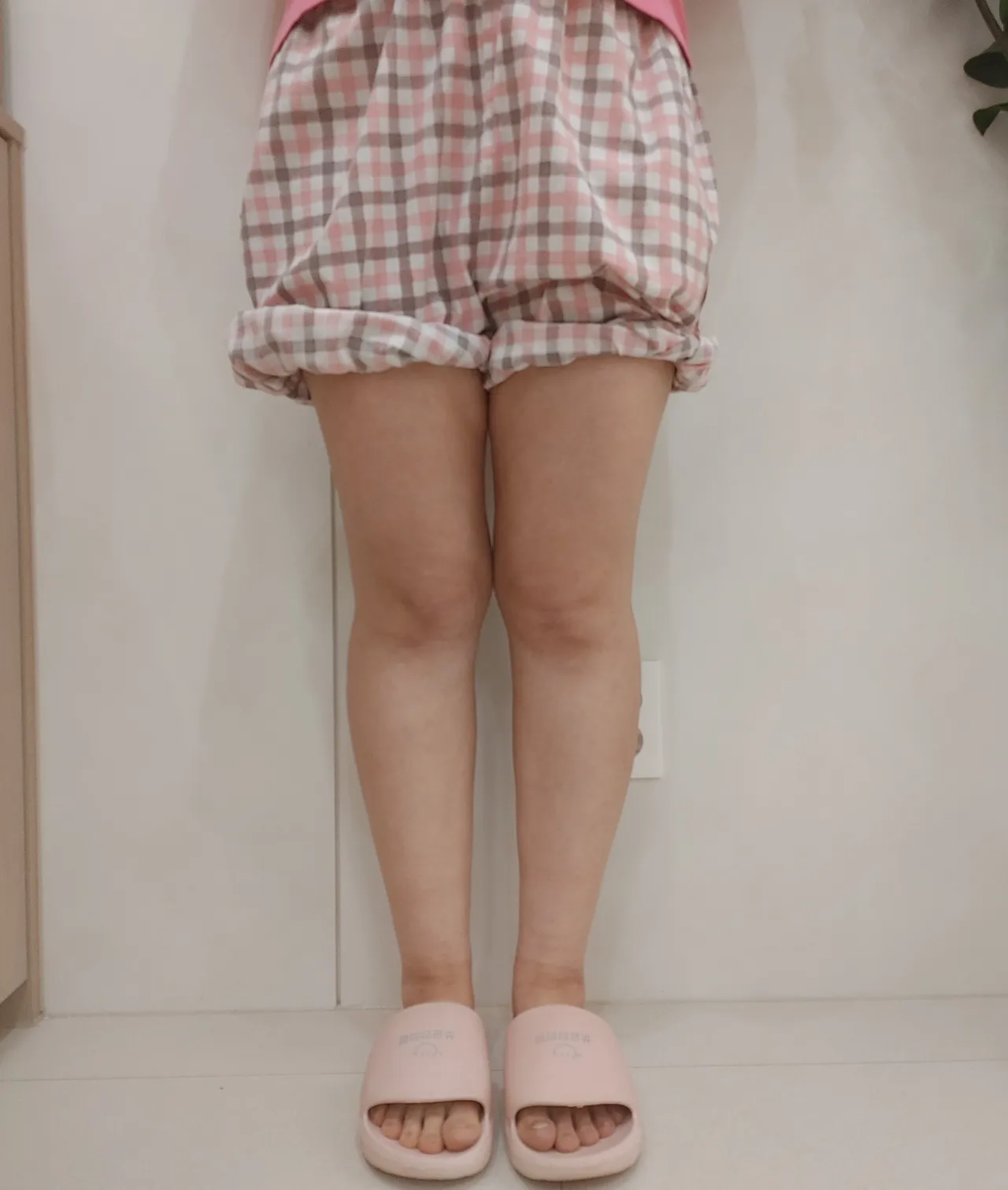 태음 체질 하지부종 개선 - 라인약침 + 림프추나 5회차 전후 - After