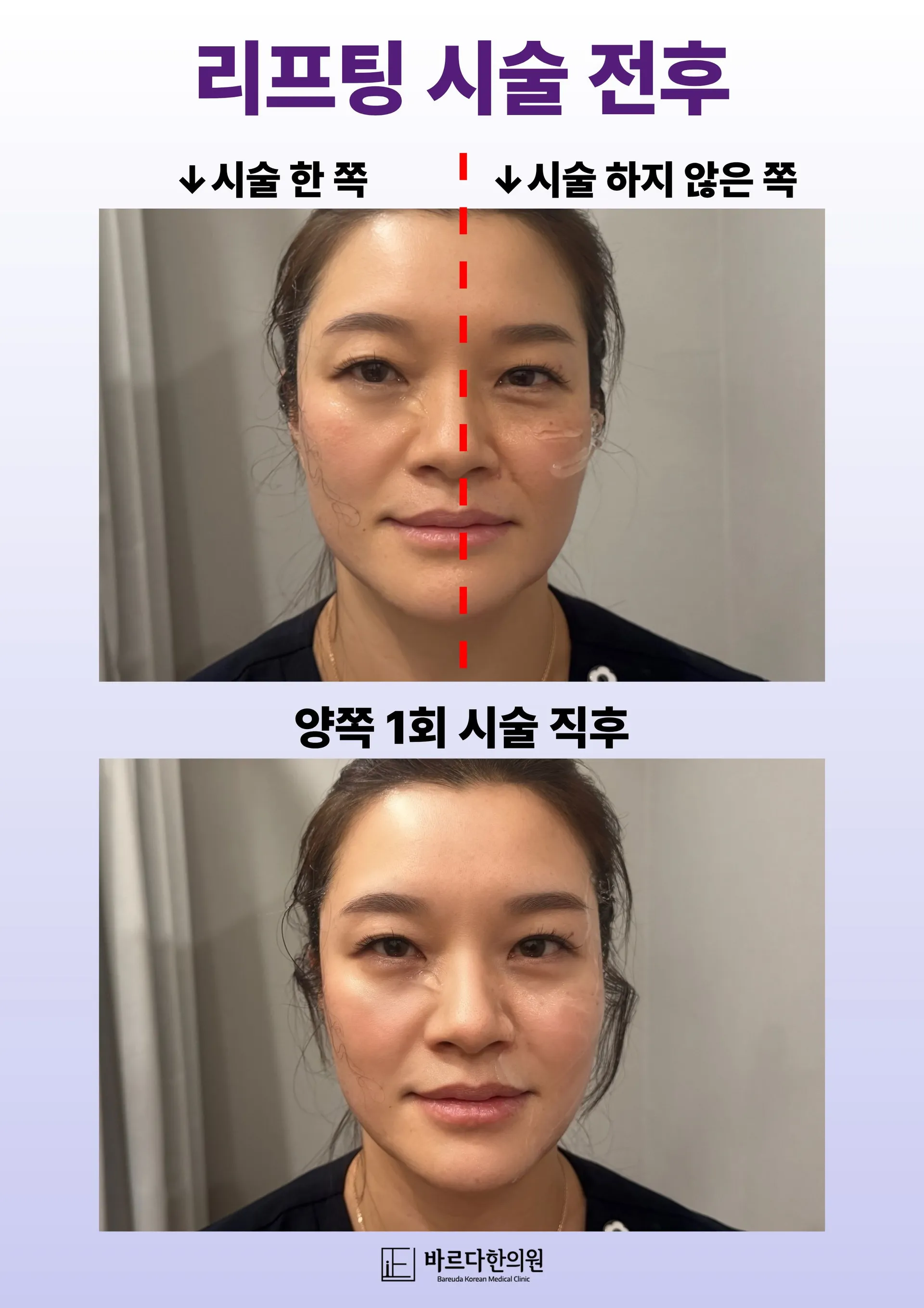 리프팅전후.jpg